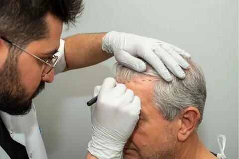 Hair Transplant in Lahore for Natural Hair Growth