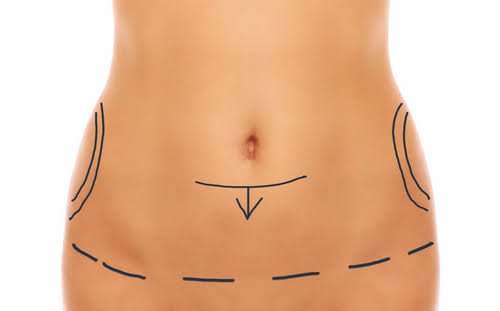 Abdominoplastie à Paris : Retrouvez une silhouette abdominale plus ferme