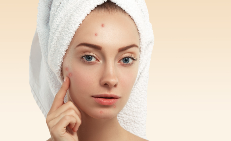 Acne Treatment in Manchester for Clearer, Healthier-Looking Skin and Improved Confidence