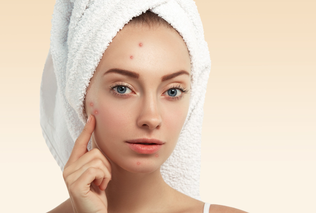 Acne Treatment in Manchester for Clearer, Healthier-Looking Skin and Improved Confidence