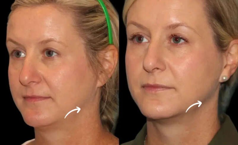 Sculptra Treatments in Dubai After Significant Weight Reduction