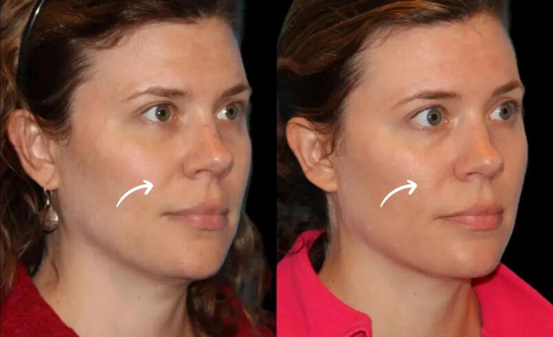 Sculptra Treatment in Dubai for Buttocks: Off-Label Research