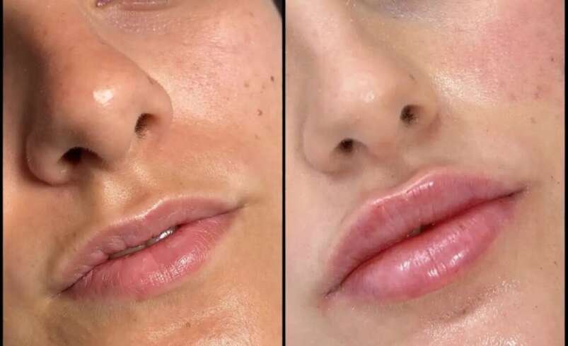 Best Aesthetic Clinic in Dubai for Fillers and Radiant Natural-Looking Result