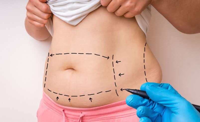 Mommy Makeover in Dubai: When Is the Best Time to Have Surgery