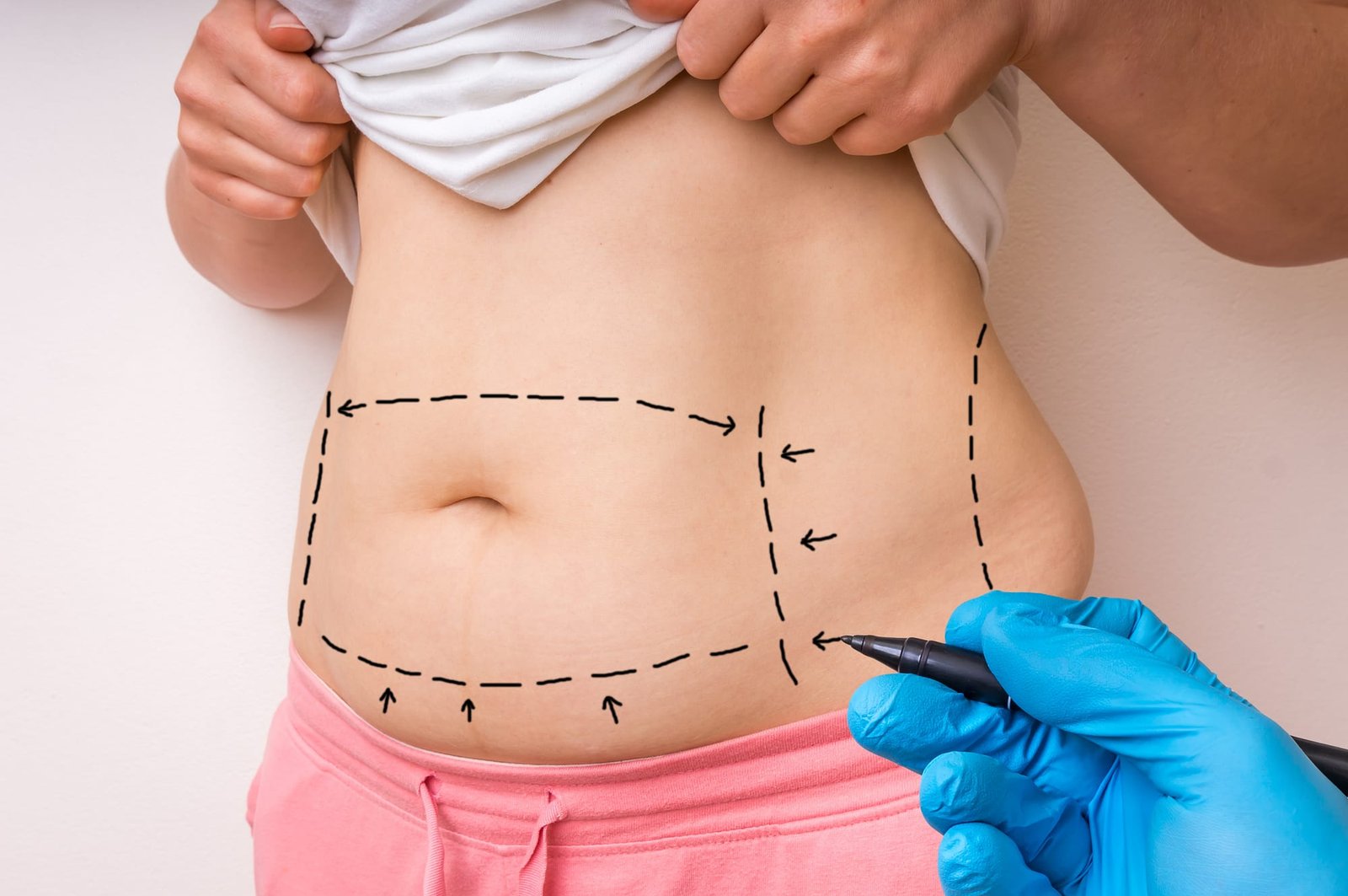 Mommy Makeover in Dubai: When Is the Best Time to Have Surgery