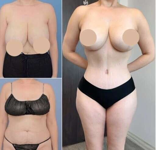 Tummy Tuck in Dubai: Reshape Your Figure with Expert Care