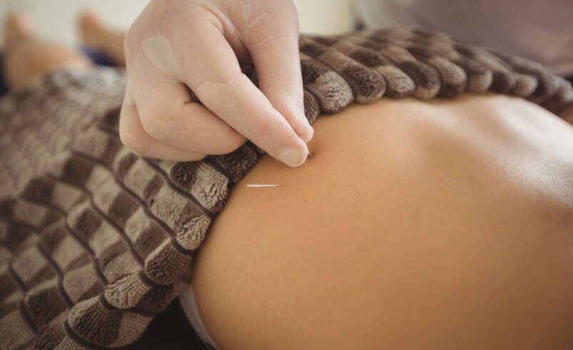 Better Days Ahead: Exploring Acupuncture for Migraine Relief