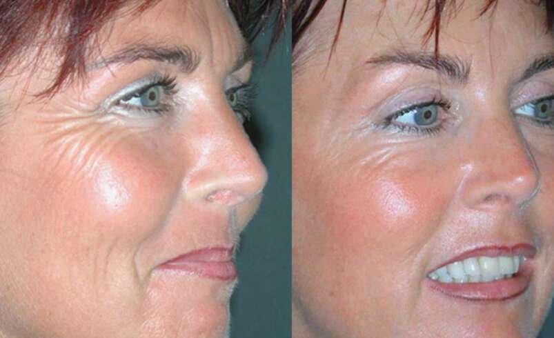 Natürlich aussehende Ergebnisse mit Botulinumtoxin für ein frisches Erscheinungsbild