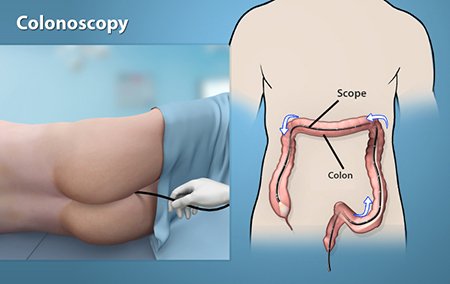 Best Hospital for Colonoscopy in Guwahati: Patient Checklist