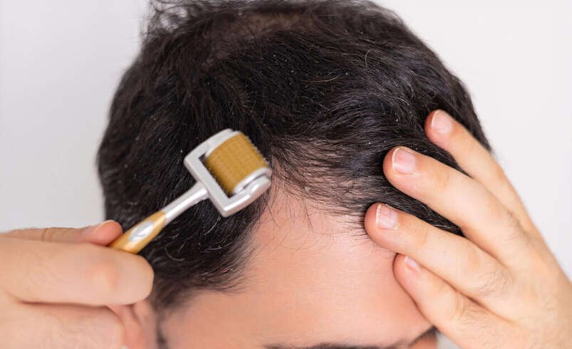 Derma Roller Treatment: Procedure, Benefits and Aftercare