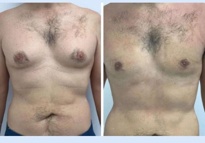 Best Doctors in Dubai for Gynecomastia: Understanding Chest Correction Goals