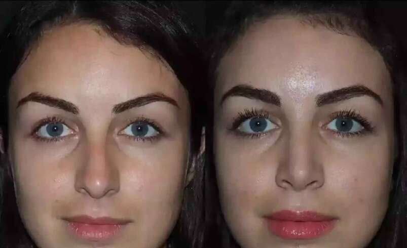 Can the Best Septoplasty Surgeon in Dubai Help Restore Nasal Airflow?