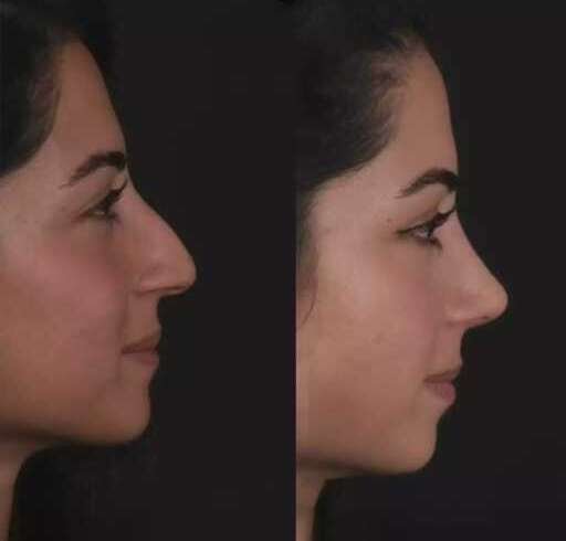Can the Best Rhinoplasty Surgeon in Dubai Correct Nasal Asymmetry?