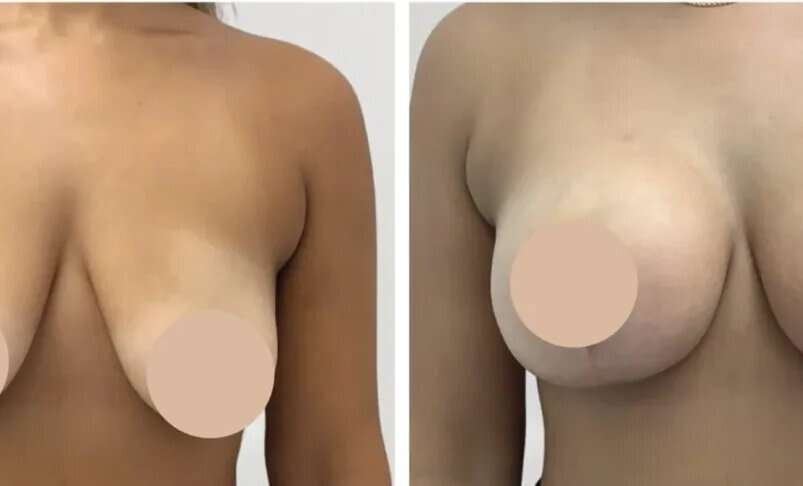 Breast Reduction in Dubai: Recovery Support and Postoperative Care