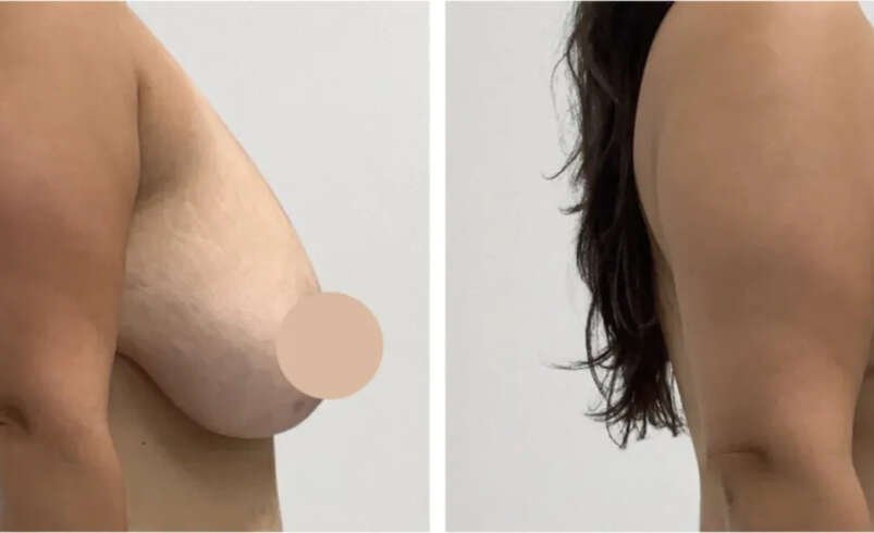 Breast Lift in Dubai for Personalized Cosmetic Solutions