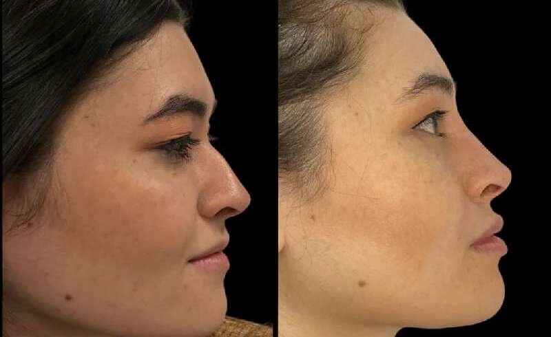 Non Surgical Rhinoplasty Dubai for Nose Contouring Options