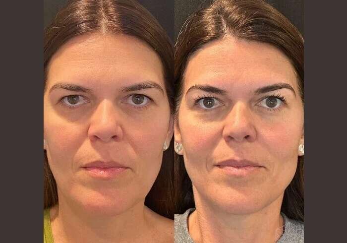 Best Plastic Surgeons in Dubai: Youthful Appearance Through Professional Thread Lift Procedures