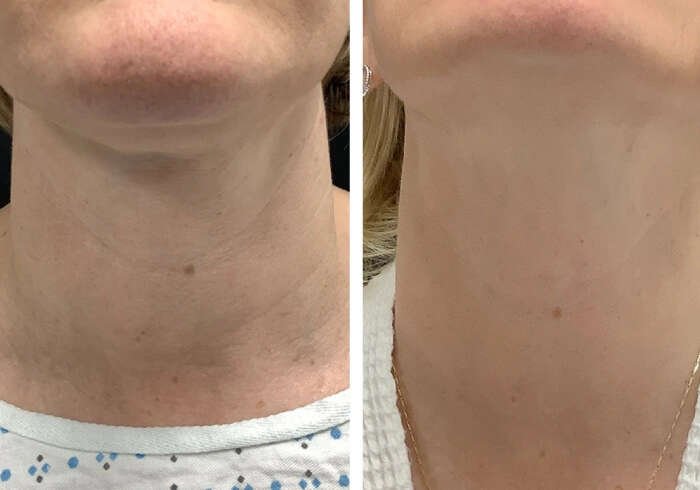 Best Aesthetic Clinics in dubai for RF Microneedling Facial Smoothness
