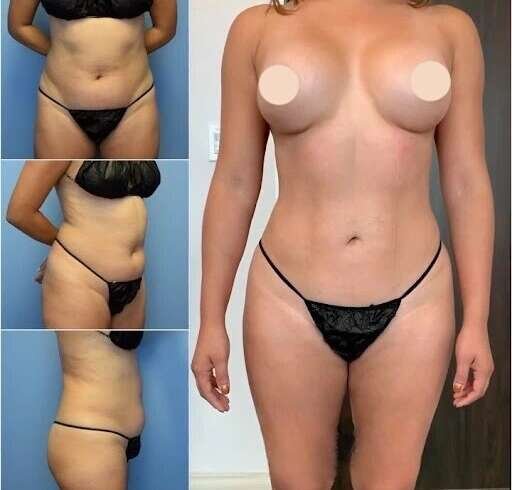 Body Contouring in Dubai for Improved Silhouette and Enhanced Body Harmony