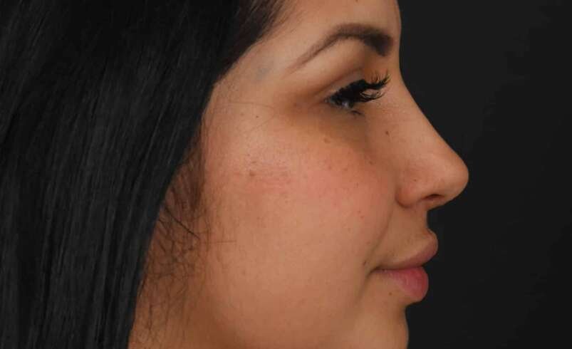 Rhinoplasty in Islamabad: Important Details to Discuss With Your Surgeon